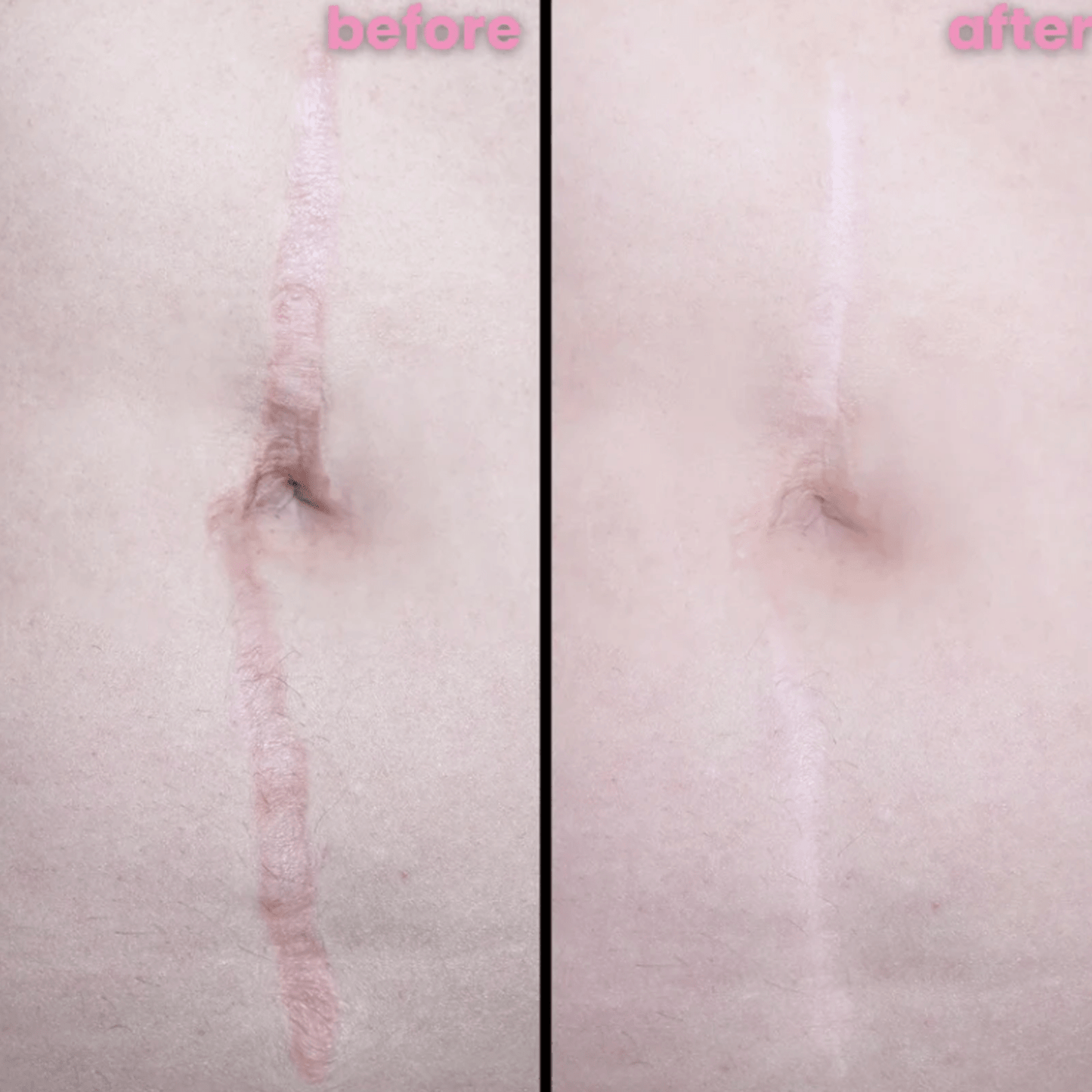 Zakdavi™ SmoothSkin Silicone Scar Sheets