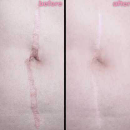 Zakdavi™ SmoothSkin Silicone Scar Sheets