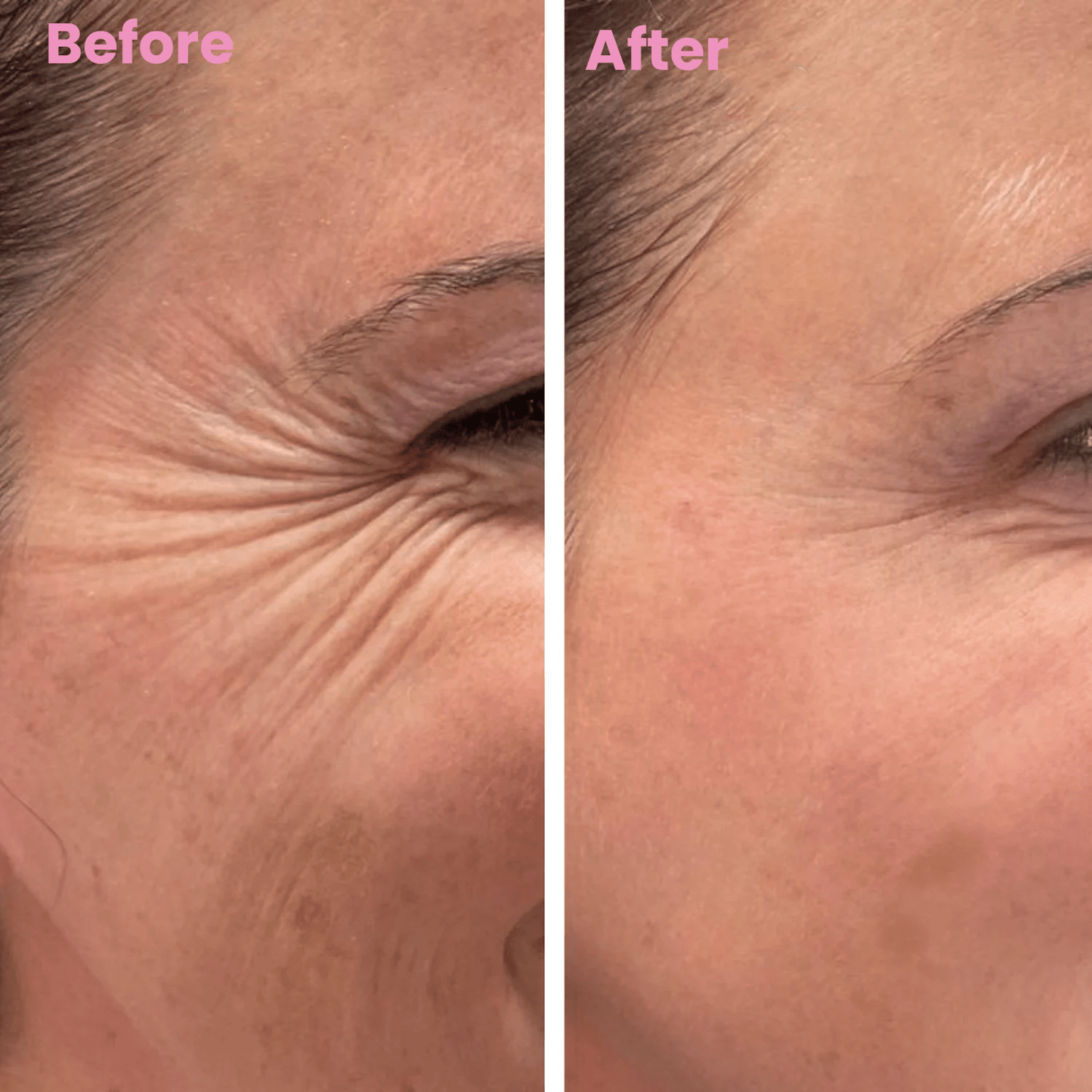 Zakdavi™ SmoothSkin Silicone Scar Sheets