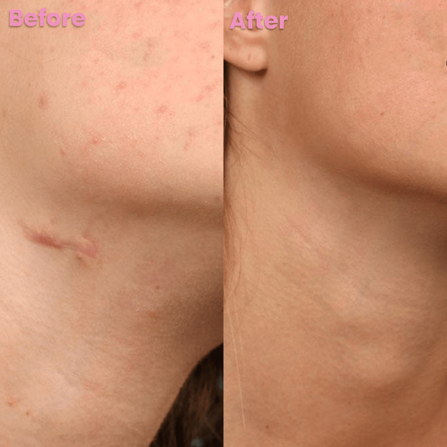 Zakdavi™ SmoothSkin Silicone Scar Sheets